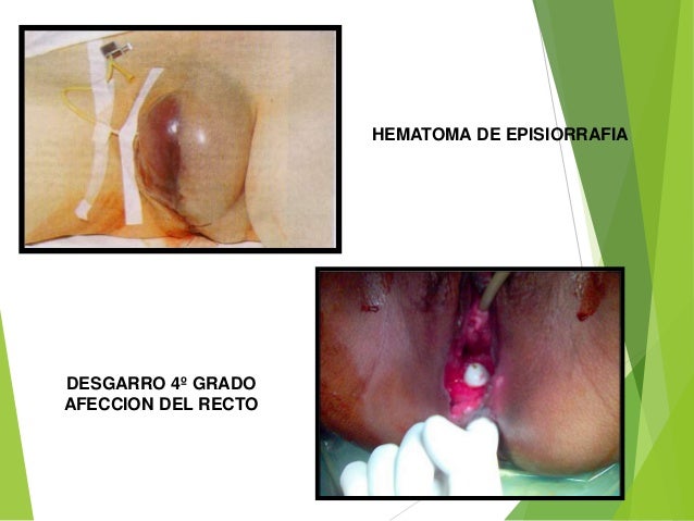 episiotomia y desgarros